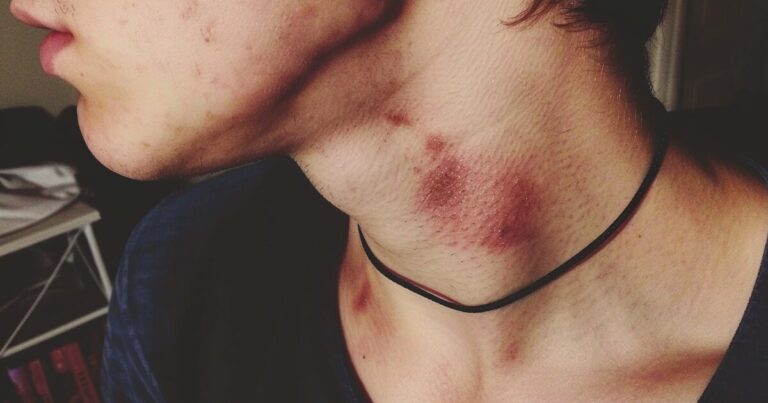 Chupetones en el cuello: cuatro plantas que ayudan a borrarlos de forma natural